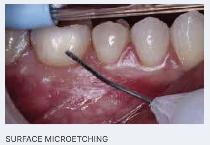 EtchMaster Surface Microetching